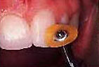 Tooth with New Resin Being Polished
